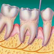 AdvancedPeriodontis